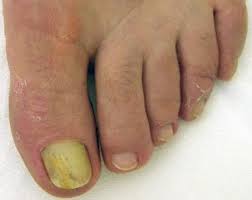Image result for onychomycosis