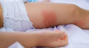 How does a child get roseola? My Child Has A Rash What To Do Cape Cod Healthcare