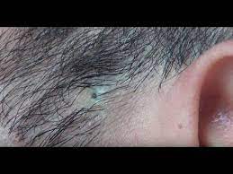 How to get rid of ingrown hairs fast best razor bump. Ingrown Hair Removal Youtube