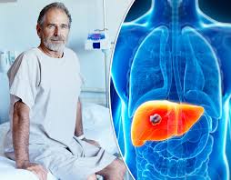 Symptoms of stage 4 liver cancer. Signs And Symptoms Of Liver Cancer Pictures Pics Express Co Uk