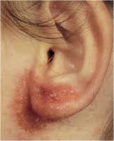 Image result for dermatitis contacta