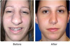How much is it to get a nose job. What Is A Rhinoplasty Best Plastic Surgeons Nose Job Nose Plastic Surgery