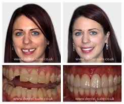 Aus diesem grund ist es heute umso wichtiger, minimal­invasiv mit der bleibenden dentition umzugehen. Leicester Loughborough Cosmetic Dentist Dentistry Treatment Practice