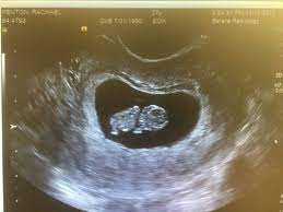 At the 20 week scan your baby's organs will be fully formed and you will get to see just how big they have grown between scans! Dating Scan Love July 2018 Birth Club Babycenter Australia