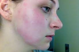 Sie trocknet die mitesser einfach aus. Mittel Gegen Mitesser Maske Aus Milch Und Gelatine Gala De