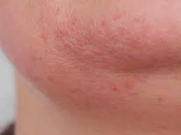 Sintomas De La Alergia Al Huevo Dieta Y Nutricion