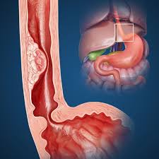 Esophageal Dilation Can Help Reduce Your Symptoms Of Gerd And Eoe Gerd Symptoms Gerd Esophagitis