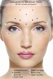Botox Injection Sites For Migraines Diagram Board Nyrania2