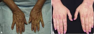 It is possible that, in some cases, the erythema extends to the fingers. Dermatomyositis Clinical Features And Pathogenesis Journal Of The American Academy Of Dermatology
