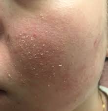 Windburned lips, also known as chapped lips, predominantly caused to your lips as soon as your skin starts losing its natural oil due to excessive cold and dehydrated dry and chapped lips in kids what is windburn treatment prevention causes and treatments for dry lips windburn symptoms prevention. Skin Concerns Extreme Windburn From Extreme 30 Celsius Cold In Canada How To Combat Flaking Skin Help Skincareaddiction