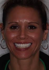 Tooth only bridge without gum tissue