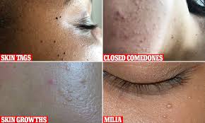 Milia are small, hard bumps that form on the skin. Skin Expert Reveals The Different Imperfections That Can Affect The Complexion Daily Mail Online