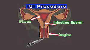 Each individual iui has a relatively low probability of success, but overall, the success rate is high. Iui Intrauterine Insemination Youtube