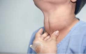 Image result for Goiter