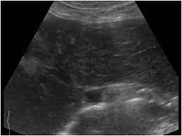 Pernah gak mendengar istilah ini? 1 1 15 Hepatitis Ultrasound Cases