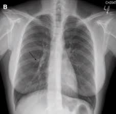 How long does nexplanon stay in your system after removal? This Popular Implant Prevents Pregnancy For Years It Could Also Go Missing In Your Body National Center For Health Research