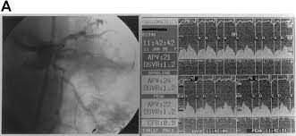 Effect of Rotablator Atherectomy and Adjunctive Balloon Angioplasty on  Coronary Blood Flow | Circulation