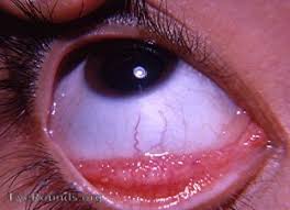 Image result for Allergic Conjunctivitis