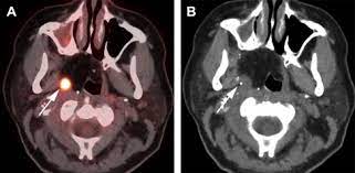 We did not find results for: Role Of Positron Emission Tomography Computed Tomography Pet Ct In Head And Neck Cancer Radiologic Clinics