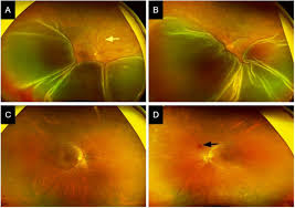 This type of rd is often associated with choroidal tumors and posterior inflammatory diseases. Bilateral Exudative Retinal Detachment And Choroidopathy As The Presenting Signs Of Malignant Hypertension Bmj Case Reports