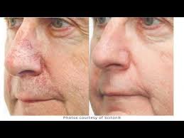 Anti Aging Treatments with Sciton BBL (Broadband Light) Laser