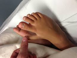 Image result for Polydactyly