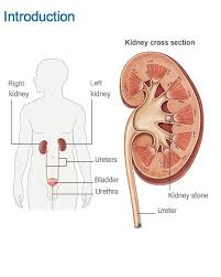 Http Www Nutrichoice4u Com Get Rid Of Kidney Stones Kidney Stones Also Known As Renal Calculi Are Small Crystal Like Substances Found In Kidney Or Any Othe