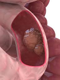 A lump or thickening may be an early or late sign of cancer and should be reported to a doctor. Small Bowel Cancer Sweden Pdf Ppt Case Reports Symptoms Treatment