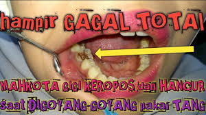 Sakit gigi juga dapat disebabkan oleh adanya gigi yang berlubang. Cabut Geraham Bawah Keropos Berat Hampir Gagal Pencabutan Di Dokter Gigi Kalimantan Ibukota Youtube