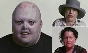 People with extreme facial differences share experiences