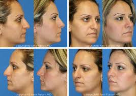 Rhinoplasty Before And After Patient Photos Rhinoplasty Rhinoplasty Before And After Nose Job