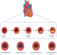 No problems, i've done this many times. The Future Of Cardiovascular Stents Bioresorbable And Integrated Biosensor Technology Hoare 2019 Advanced Science Wiley Online Library