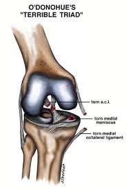 Ligaments surround a joint to give it support and limit its movement. Anterior Cruciate Ligament Acl Tears Orthopedic Associates Of Hartford