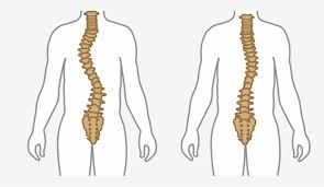 It can happen as a result of injury or nerve damage. Causes And Symptoms Of Scoliosis Huffman Spine Clinic Scoliosis