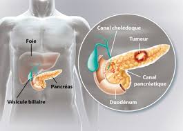 Comment Savoir Si J Ai Un Cancer Du Pancreas Clinique Des Cedres