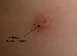 Bestreviews.com has been visited by 1m+ users in the past month How To Remove A Tick Head Stuck In Your Skin Mom Goes Camping