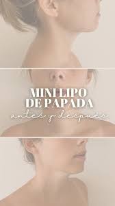 💥 Resultados que hablan por sí solos. , Con la mini lipo de papada, el  cambio se nota… ¡y se disfruta!, 📸 El “antes y después” es sutil pero  poderoso:, ✔ Se define el ángulo mandibular, ✔ Se reduce ...