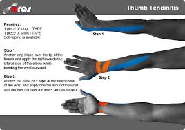 Tennis injuries are generally defined as either cumulative, meaning they occur from overuse. Kinesiology Tape Can Help To Prevent Common Condition That Affects The Tendons That Are Used To Straighten You Kinesiology Taping Hand Therapy Thumb Tendonitis