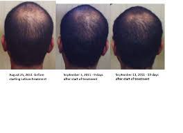 Carefully applying the drops is your best defense against this occurring. Hair Loss Forum I M Currently Going Through Latisse Treatment At Home For Baldness