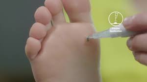Vinegar also has natural antimicrobial properties that may help fight hpv, but more studies are necessary. How To Use Scholl Verruca Wart Complete Treatment Pen Youtube