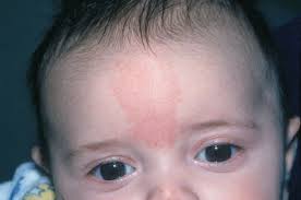 Image result for Nevus Simplex