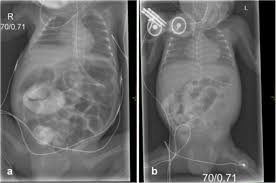 Cystic fibrosis (cf) is a genetic disorder that affects mostly the lungs, but also the pancreas, liver, kidneys, and intestine. Mukoviszidose Zystische Fibrose Symptome Diagnose Therapie
