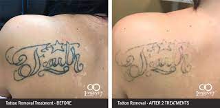 This advanced laser technology uses light energy to absorb ink fragment from the tattoo, which allows the tattoo to fade naturally over time. Tattoo Removal Okc 20 Off 1 Rated Med Spa Straightforward Pricing Longevity Med Spa