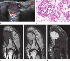 Image result for Glomus tumor