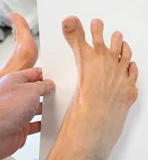 Image result for Hallux Varus