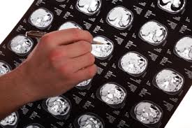 About 30 percent of u.s. Risk Of Brain Metastasis In Colorectal Cancer Dependent On Tumor Location And Other Metastatic Sites Cancer Therapy Advisor