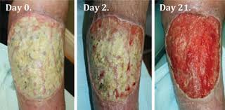 The muscles and bones are now visible; Easy Slough Removal Enluxtra