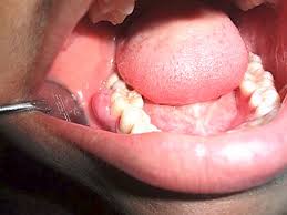 Image result for granuloma gum disease