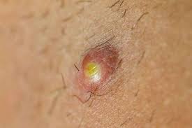 Meskipun beberapa studi kasus telah dilaporkan, terapi antiretroviral (art) pada zaman modern umumnya tidak menyebabkan rambut rontok. Folikulitis Gejala Penyebab Dan Mengobati Alodokter