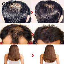 Keratin shampoo works by covering the hair shafts with a new protective coating. Oedo Hair Care Essence Morocco Ginseng Keratin Treatment Hair Loss Repair Serum Women Men Hair Growth Powder Product Hair Scalp Treatments Aliexpress